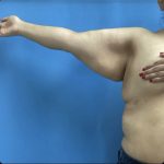 Brachioplasty Before & After Patient #14839