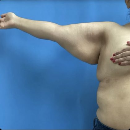 Brachioplasty Before & After Patient #14839