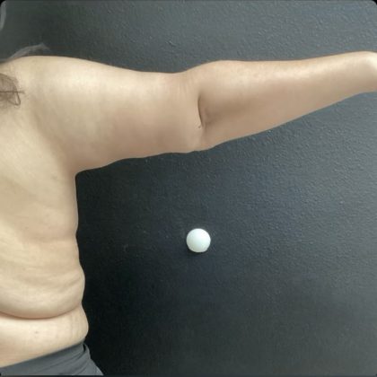 Brachioplasty Before & After Patient #14839