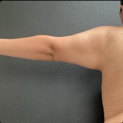 Brachioplasty Before & After Patient #14838
