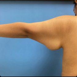 Brachioplasty Before & After Patient #14838