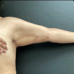 Brachioplasty Before & After Patient #14838