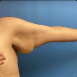 Brachioplasty Before & After Patient #14838