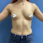Breast Augmentation Before & After Patient #14814