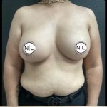 Breast Augmentation Before & After Patient #14812