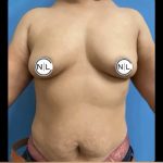 Breast Augmentation Before & After Patient #14812