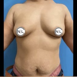 Breast Augmentation Before & After Patient #14812