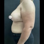 Breast Augmentation Before & After Patient #14812