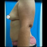 Breast Augmentation Before & After Patient #14812