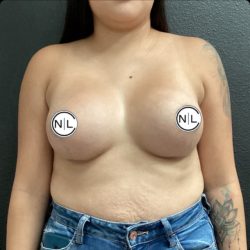 Breast Augmentation Before & After Patient #14807