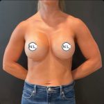 Breast Augmentation Before & After Patient #14800