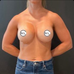 Breast Augmentation Before & After Patient #14800
