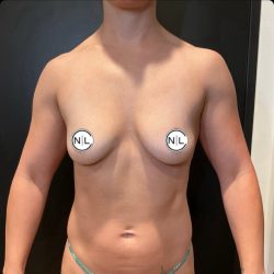 Breast Augmentation Before & After Patient #14800