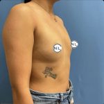 Breast Augmentation Before & After Patient #14833