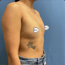 Breast Augmentation Before & After Patient #14833