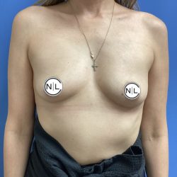 Breast Augmentation Before & After Patient #14831