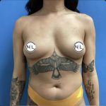 Breast Augmentation Before & After Patient #14829