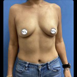 Breast Augmentation Before & After Patient #14828
