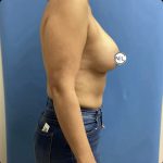 Breast Augmentation Before & After Patient #14828