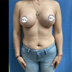 Breast Augmentation Before & After Patient #14827