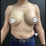 Breast Augmentation Before & After Patient #14822