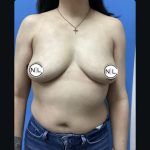 Breast Augmentation Before & After Patient #14822