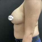 Breast Augmentation Before & After Patient #14822