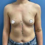 Breast Augmentation Before & After Patient #14817