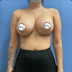 Breast Augmentation Before & After Patient #14815