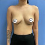 Breast Augmentation Before & After Patient #14815