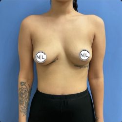 Breast Augmentation Before & After Patient #14815