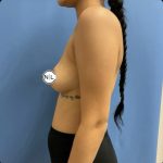 Breast Augmentation Before & After Patient #14815