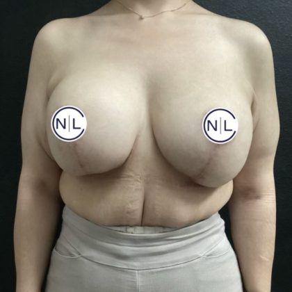 Breast Lift Before & After Patient #14837