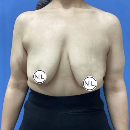 Breast Lift Before & After Patient #14837