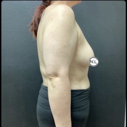 Breast Lift Before & After Patient #14835