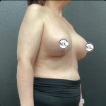 Breast Lift Before & After Patient #14835