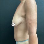 Breast Reduction Before & After Patient #14834