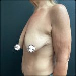 Breast Reduction Before & After Patient #14834