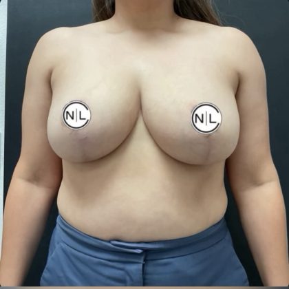 Breast Reduction Before & After Patient #14836