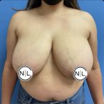 Breast Reduction Before & After Patient #14836