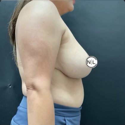 Breast Reduction Before & After Patient #14836