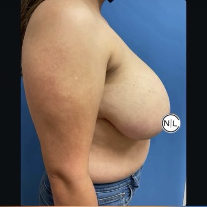 Breast Reduction Before & After Patient #14836