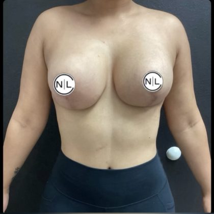 Breast Revision Before & After Patient #14866