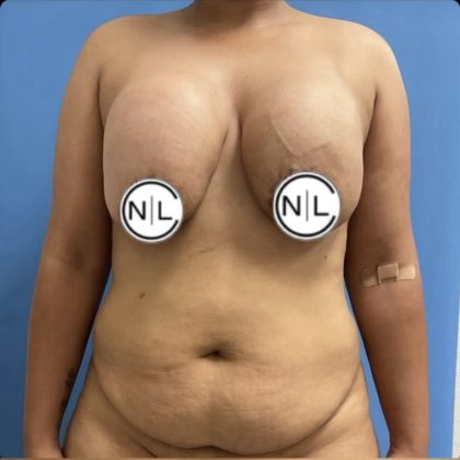 Breast Revision Before & After Patient #14866