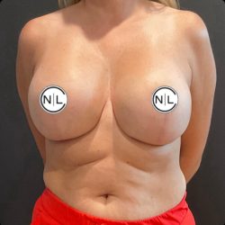 Breast Revision Before & After Patient #14864