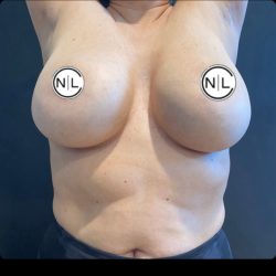 Breast Revision Before & After Patient #14864