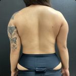 Liposuction Before & After Patient #14875