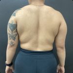 Liposuction Before & After Patient #14875