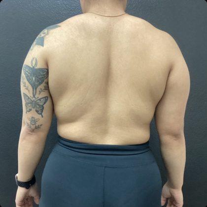 Liposuction Before & After Patient #14875
