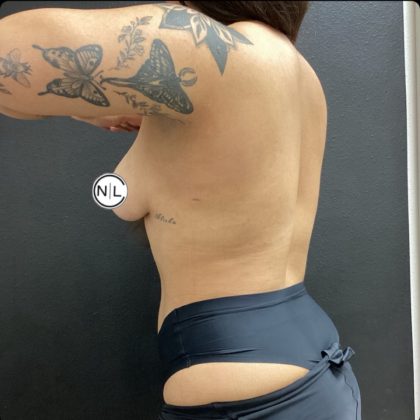 Liposuction Before & After Patient #14875
